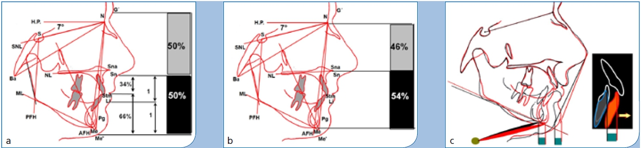 Abb. 36 a–c: a) u. b): Die Fernröntgenaufnahme nach Abschluss der Behandlung zeigt eine harmonische Relation der skelettalen Strukturen sowohl in der Sagittalen als auch in der Vertikalen sowie eine Harmonisierung im Weichteilprofil zwischen Ober- und Untergesicht. c) Die Überlagerung der FRS-Aufnahmen vor (schwarz) und nach (rot) der Behandlung zeigt, dass es durch die chirurgische Translation zu einer Vorverlagerung der Kinnprominenz (SN-Pg hat sich um 3,5° vergrößert) kam und dementsprechend zu einer Streckung der suprahyoidalen Muskulatur.