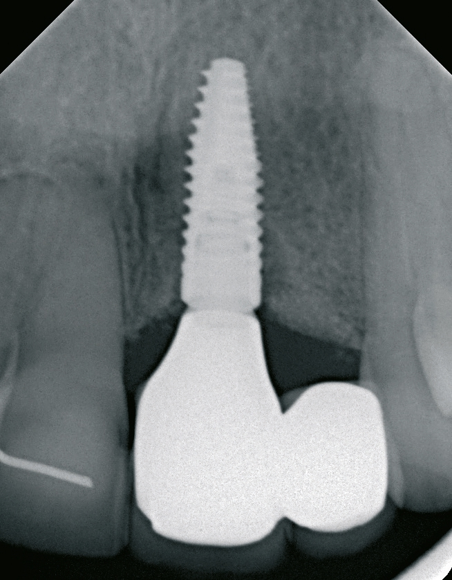 Abb. 35: Der definitive Zahnersatz mit Implantat in der Röntgenkontrolle.