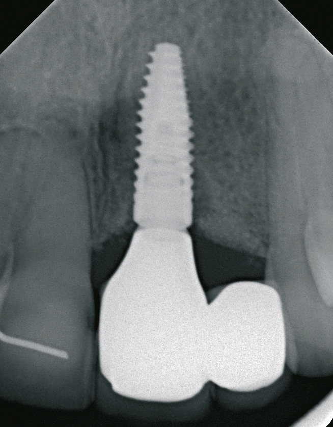 Abb. 35: Der definitive Zahnersatz mit Implantat in der Röntgenkontrolle.