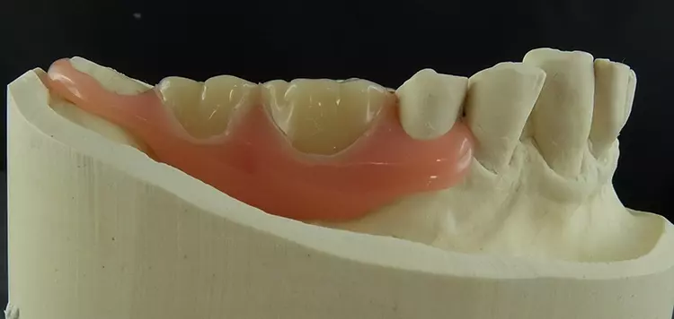 Abb. 42: Die fertig ausgearbeitete Unterkieferteilprothese mit flexiblen Zahnfleischklammern.