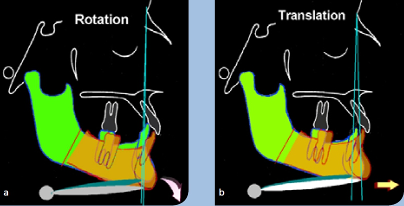 Abb. 38 a u. b: Veranschaulichung der Wirkung unterschiedlicher Verlagerungen; bei der Rotation tritt eine minimale Streckung z. B. des Musculus digastricus ein (a), während diese bei der Translation sehr stark ist (b).