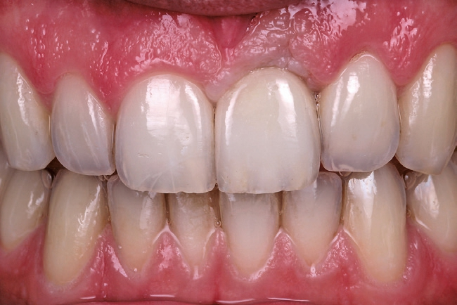 Abb. 42: Nach dem Einschrauben der Implantatkrone blieb die Gingiva noch einige Minuten anämisch..