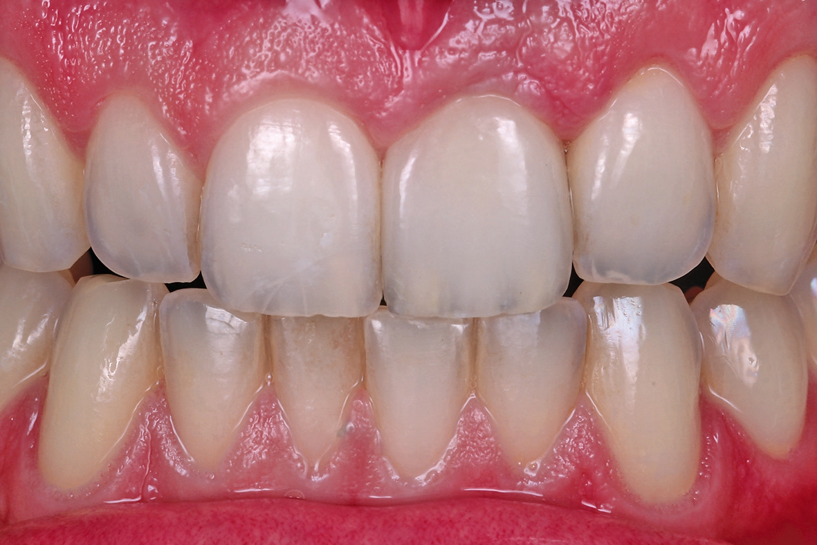 Abb. 43: Sechs Wochen nach der Eingliederung hat sich die Gingiva beruhigt und bereits an die Implantatkrone angelegt. Mesiozervikal hat sich das vernarbte Gewebe des ursprünglichen Unfalls etwas über die Krone gelegt.
