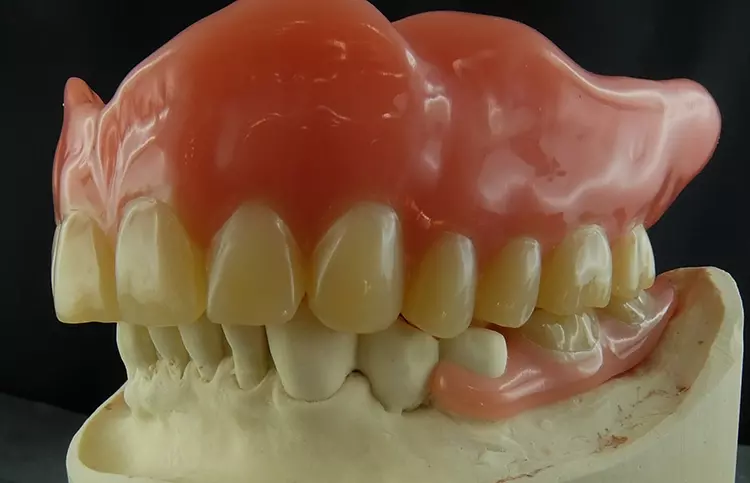 Abb. 46: Funktionelle, ästhetische Totalprothese. Wobei der Vorteil von individuell gefrästen Zähnen bei der optimal einzustellenden Okklusion liegt. Auf der linken Seite wurde aufgrund der ungleichmäßigen Kauebene auf einen bukkalen Kontakt bei 35 verzichtet.