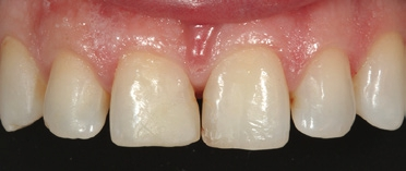 Abb. 57: Ältere mesiale Klasse-IV-Kompositrestauration auf Zahn 11, insuffiziente Klasse-III-Füllung mesial an Zahn 21 sowie mesiale und distale Lücke des leicht nach labial geneigten Zahnes 12.