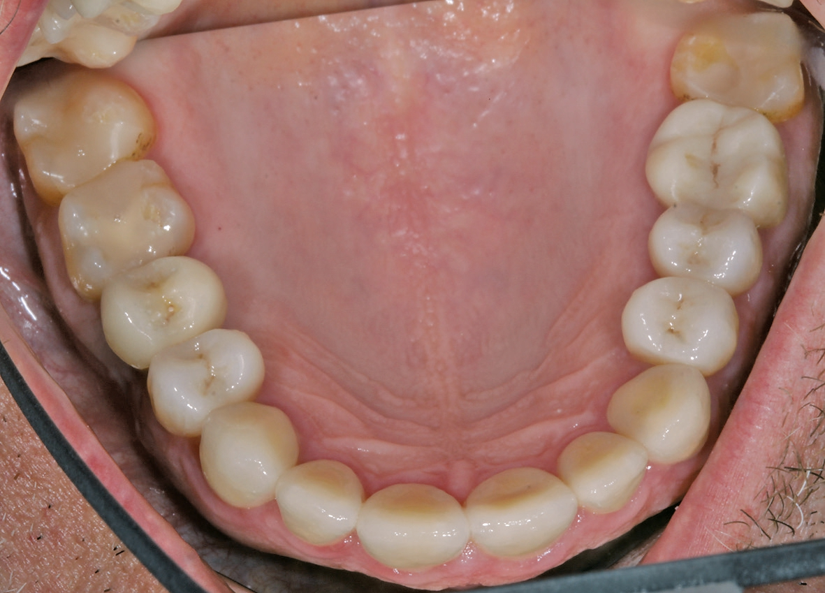 Abb. 31b: Endergebnis im Oberkiefer.