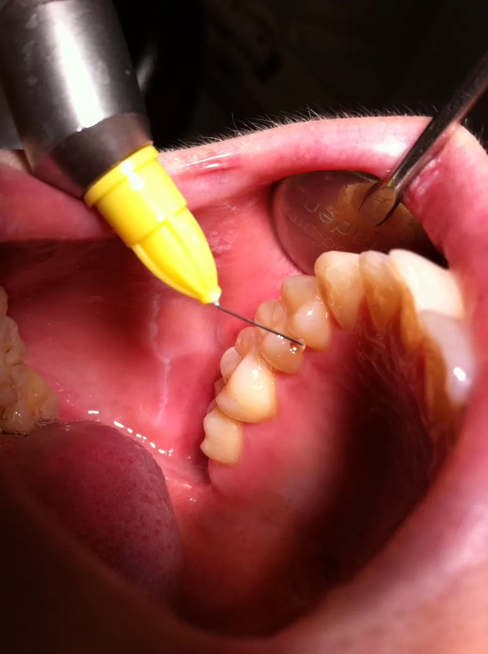 Abb. 3: Ein Tropfen des Anästhetikums reduziert die Sensibilität der Gingiva.