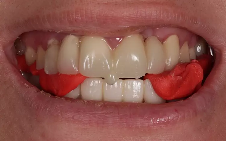 Abb. 4: Zentrikbissnahme mittels Frontjig und GC Bite Compound nach Gutowski.