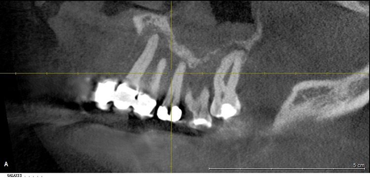 Abb. 4: Ausgangsbefund, Ausschnitt DVT.