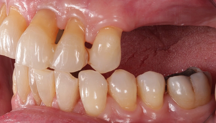 Abb. 4: Laterotrusion rechts.