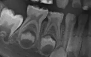 Abb. 4a–e: Bei der Hall-Technik wird eine Stahlkrone ohne Lokalanästhesie, Kariesentfernung oder Präparation über einen kariösen Milchmolaren zementiert, für den eine irreversible Pulpitis bzw. Pulpanekrose ausgeschlossen werden sollte. Eine Dentinbrücke im Röntgenbild (b) ist dafür ein guter Marker. Über die Stahlkronenversorgung wird die Kariesaktivität heruntergeregelt und es werden enorm hohe Erfolgsraten erzielt, die der konventionellen Füllungstherapie klar überlegen sind.