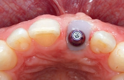 Abb. 52: Der individualisierte Abformpfosten wird sorgfältig auf dem enossalen Implantat verschraubt.