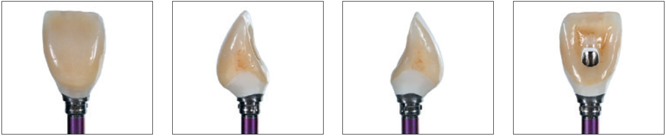 Abb. 57–60: Definitive Hybridabutmentkrone: Ästhetisch hochwertige Verblendung aus Schichtkeramik auf einem individuellen Zirkonoxidaufbau, der auf einer konfektionierten Titanbasis verklebt wurde. Die Ansicht aus unterschiedlichen Blickwinkeln zeigt das Emergenzprofil von allen Seiten.