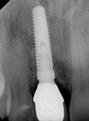 Abb. 61: Der korrekte Sitz der verschraubten Hybridabutmentkrone wird mit einem Röntgenbild kontrolliert. Das Implantat zeigt eine stabile Osseointegration.