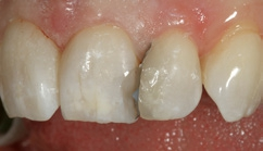 Abb. 57: Weiterer Aufbau in der Universalfarbe und inzisal-labial mit etwas Schmelzfarbe.
