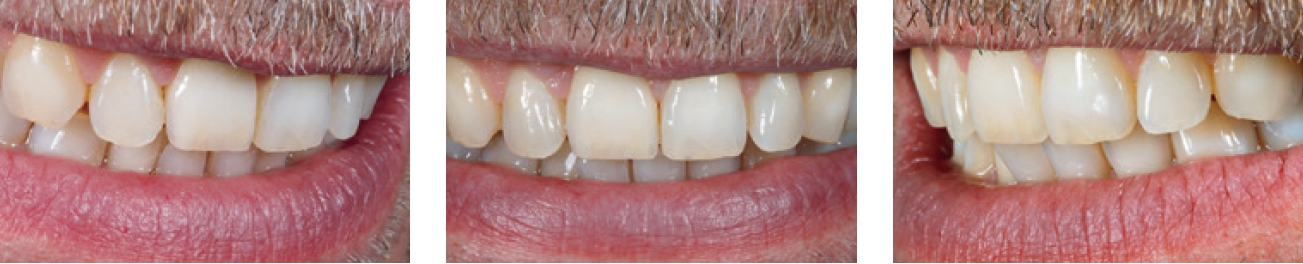 Abb. 63–65: Das Zusammenspiel von Lippen und prothetischer Arbeit ergibt ein harmonisches Gesamtbild.
