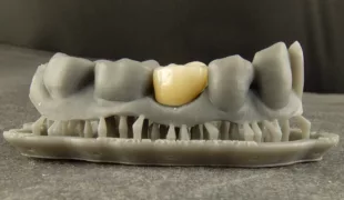 Gedrucktes Modell (Formlabs) mit definitiver Krone.