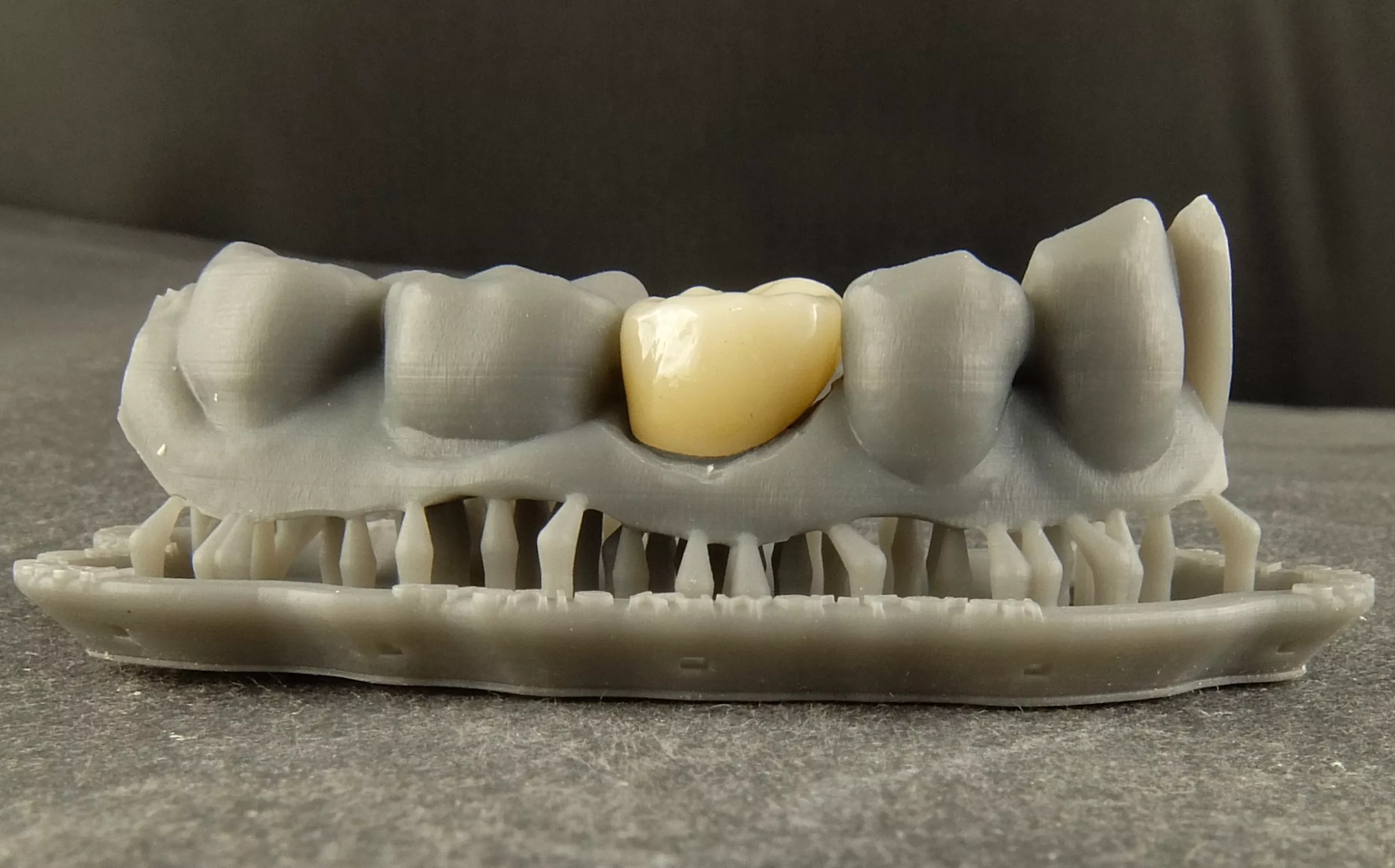 Gedrucktes Modell (Formlabs) mit definitiver Krone.