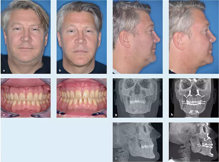 Abb. 5: Patient mit schwerer obstruktiver Schlafapnoe und CPAP-Intoleranz, Klasse-I-Okklusion, Therapie durch ein bimaxilläres Rotationsadvancement mit Kinnrandverschiebung unter Erhalt der neutralen Bisslage.
a: Patient en face prä op.
b: Patient en face 2 Jahre post op.
c: Profil prä op.
d: Profil 2 Jahre post op.
e: Okklusion prä op.
f: Okklusion 2 Jahre post op.
g: DVT en face prä op.
h: DVT en face 6 Wochen post op.
i: DVT Profil prä op.
j: DVT Profil 6 Wochen post op.
