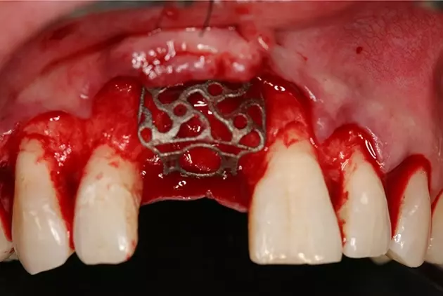 Abb. 5: Patientenspezifisches Titangitter in situ während der Einprobe.