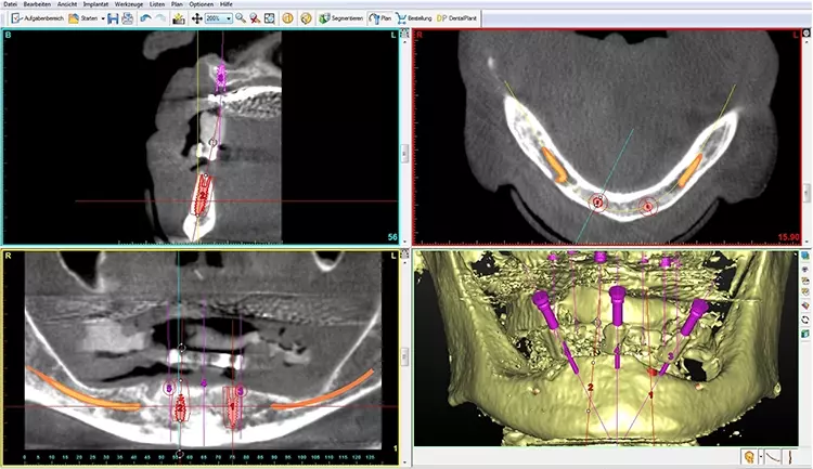 Abb. 5: Positionieren der Implantate im SimPlantProgramm.