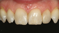 Abb. 61: En-face-Ansicht bei der 6-Monats-Nachuntersuchung: Alle Restaurationen (11, 21 und 22) fügen sich ästhetisch perfekt in die vorhandene Zahnhartsubstanz ein; die Gingiva ist reizlos, die schwarzen Dreiecke bleiben verschwunden.