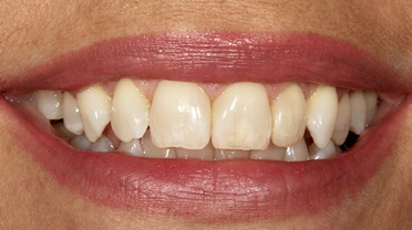 Abb. 62: Lippen-Abschlussbild der hochzufriedenen Patientin.