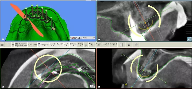 Abb. 6: Adäquate 3D-Planung der zu inserierenden Miniimplantaten