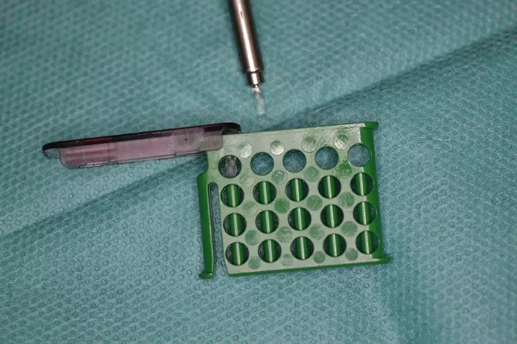 Abb. 7: Entnahme des kopfl osen SonicPins aus dem Transfergefäß.