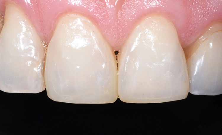 Abb. 7: Fertige Restauration nach Rehydrierung der Zahnhartsubstanz. Die Übergänge zwischen Zahnhartsubstanz und Restauration sind nur in großer Vergrößerung zu erkennen und klinisch nicht relevant.