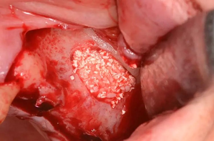 Abb. 7: Implantation regio 25, 27.