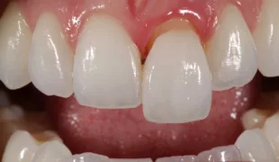 Ein Material – viele Anwendungsmöglichkeiten: Einzelzahnkrone (21), IPS e.max ZirCAD Prime, BL1 auf dunklem Stumpf, teilverblendet.