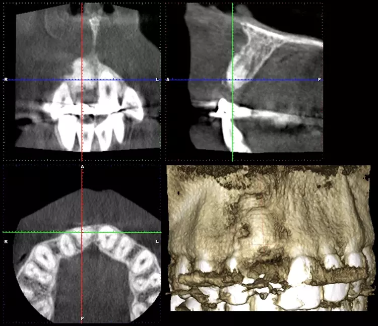 Abb. 9: Dreidimensionale Bildgebung prä implantationem mit sichtbar eingeheiltem
Augmentat regio 11.