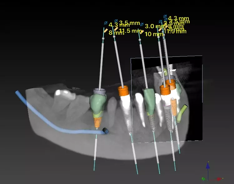 Abb. 9: Ermittlung der Implantatpositionen mit Planungssoftware im UK mit
anschließendem Datentransfer zur Herstellung einer Chirurgieschablone (Nobel
Guide, Nobel Biocare).