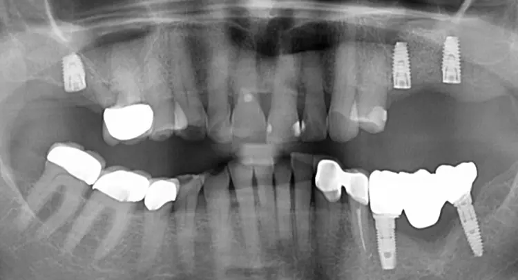Abb. 9: Röntgenkontrolle Implantation.
