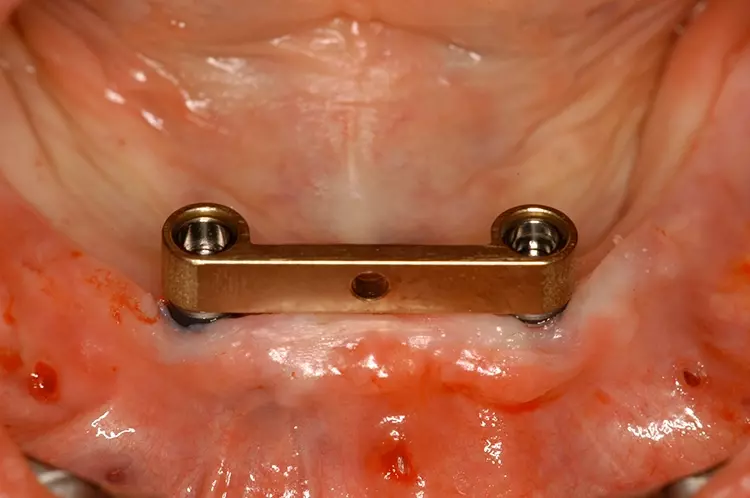 Abb. 9: Kontrolle der Insertionstiefe mit dem Steg.