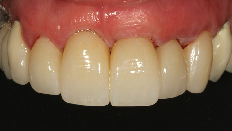 Abb. 20: Behandlungsergebnis unmittelbar nach Abnahme des Kofferdamms in Ansicht von labial.
