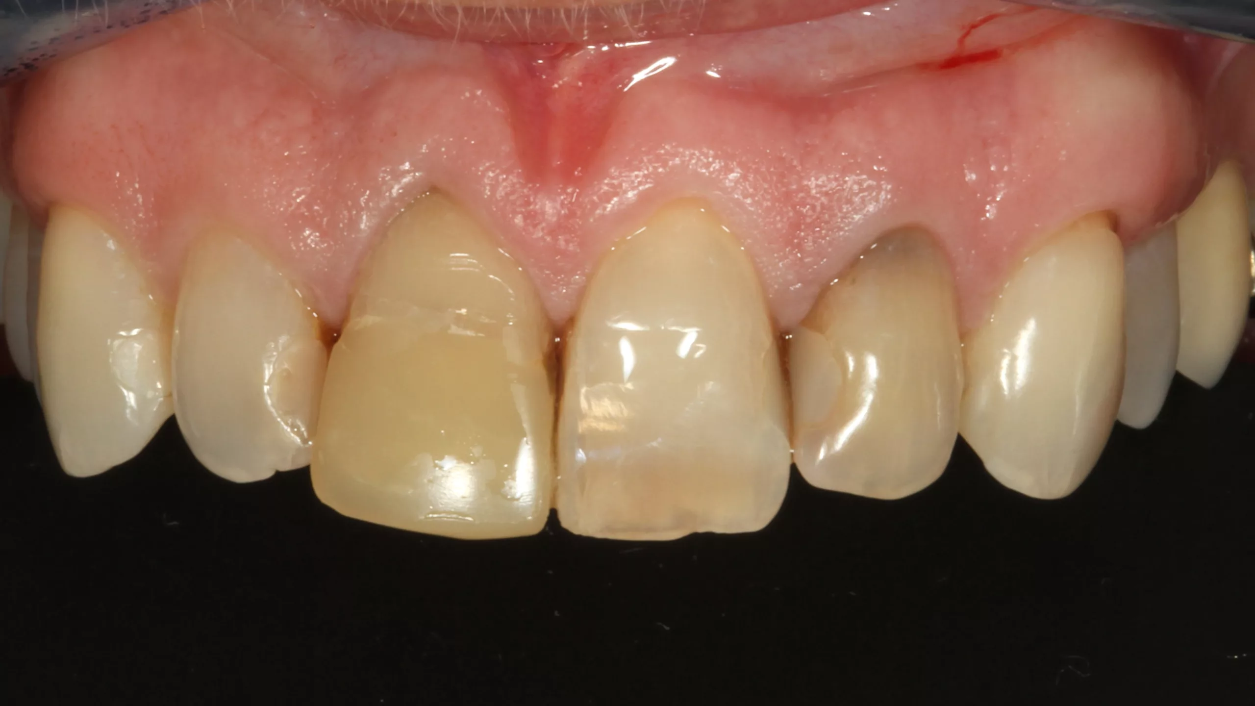 Abb. 29: Von der Patientin als unästhetisch empfundene Frontzahnsituation.