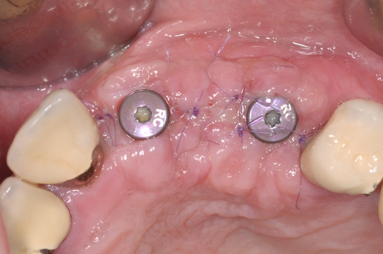Abb. 15: Eine Woche postoperativ nach Freilegung der Implantate.