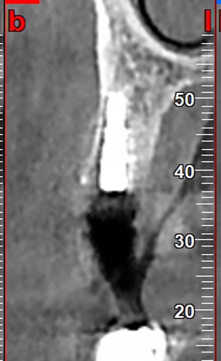 Abb. 11: Radiologische Kontrolle nach der palatinalseits orientierten Insertion.