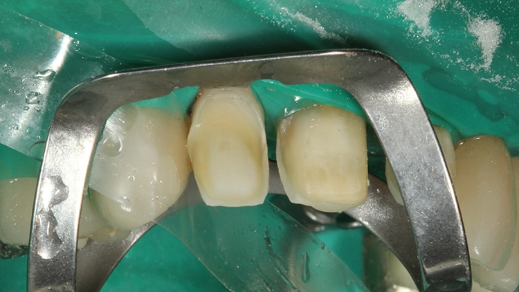 Abb. 17: Einwirken des Visalys Tooth Primers.