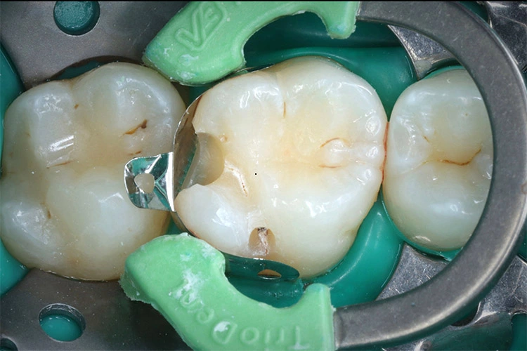 Abb. 7: Ansicht 16 nach Platzieren der bereits anatomisch vorgewölbten Matrize.