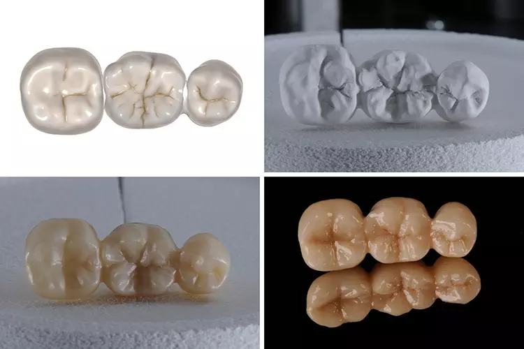 Abb. 10: Workflow zur Herstellung einer dreigliedrigen Unterkieferseitenzahnbrücke
aus IPS e.max ZirCAD Prime.
