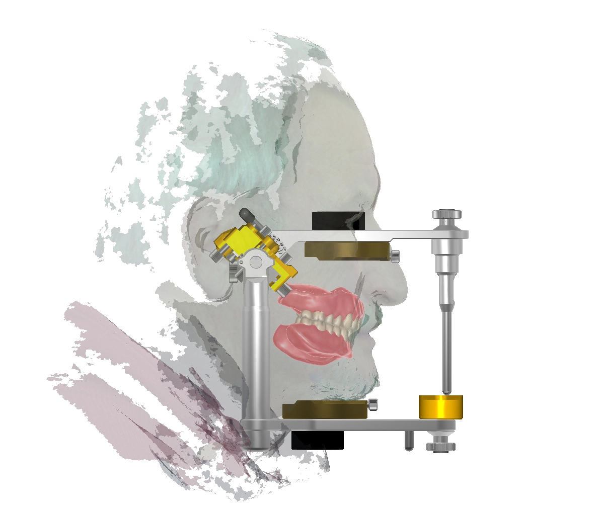 Eine virtuelle Analyse und digitales Set-Up einer Totalprothese unter Zuhilfenahme eines Gesichtsscans (©Schweiger).