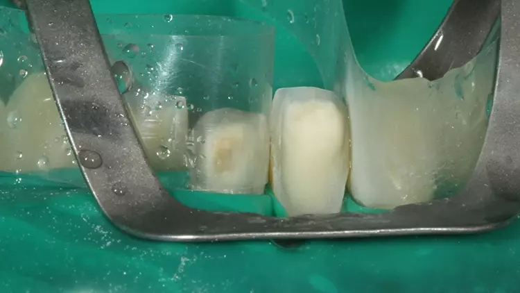 Abb. 10: Vorbehandlung der Klebefläche des Zahnes 31 zur adhäsiven
Befestigung des Veneers. Die Oberfläche wurde gerade mit 50 μm Al2O3
abgestrahlt.