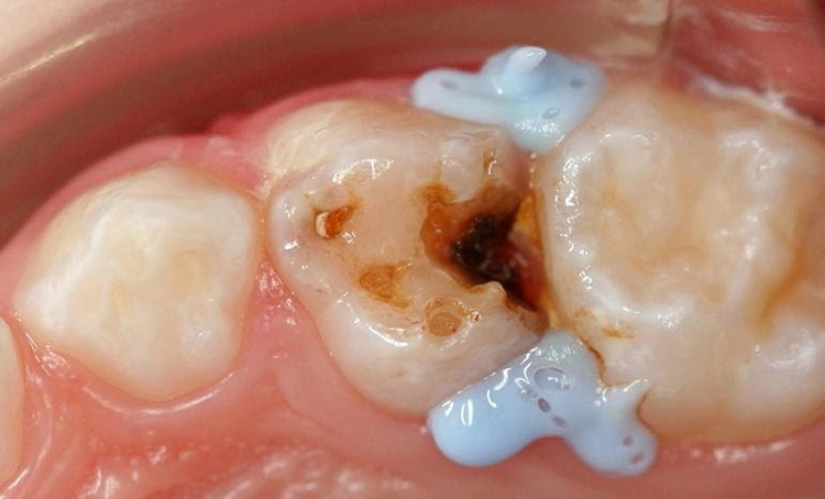 Abb. 10: Eine Isolation der Gingiva mittels flüssigen Kofferdams ist empfehlenswert, um eine Verfärbung dieser Bereiche zu vermeiden (Foto: ZA Mourad).