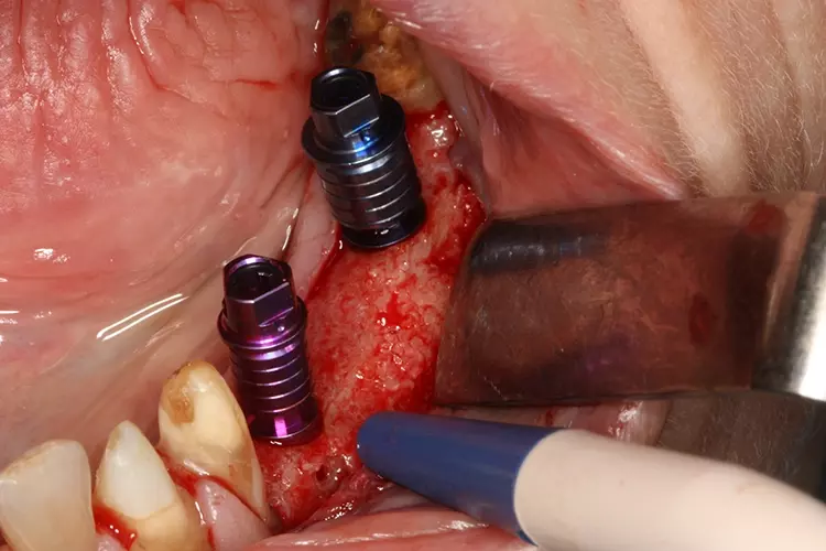 Abb. 10: Inserierte Conelog Implantate in regio 35 (4,3/11 mm) und 37 (5,0/11mm).