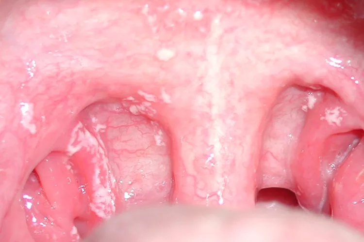 Mundsoor = orale Candidiasis: abstreifbare Beläge.