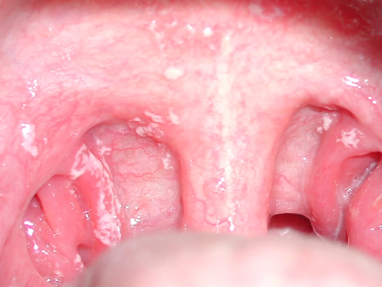 Abb. 10: Mundsoor = orale Candidiasis: abstreifbare Beläge.