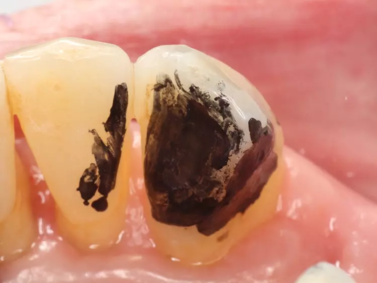 Abb. 10: Anfärben der geplanten Klebefläche mittels wasserfester Farbe.